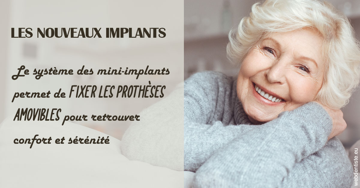 https://www.cabinetdentaire-etoile.fr/Les nouveaux implants 1