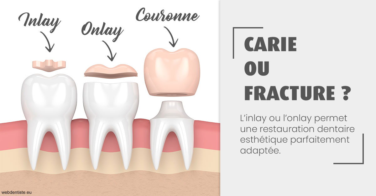 https://www.cabinetdentaire-etoile.fr/T2 2023 - Carie ou fracture 1