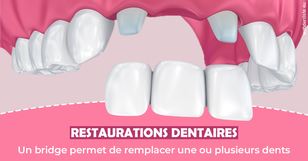https://www.cabinetdentaire-etoile.fr/Bridge remplacer dents 2