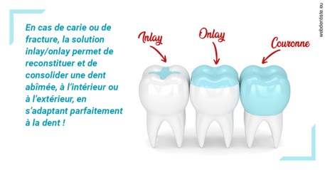 https://www.cabinetdentaire-etoile.fr/L'INLAY ou l'ONLAY