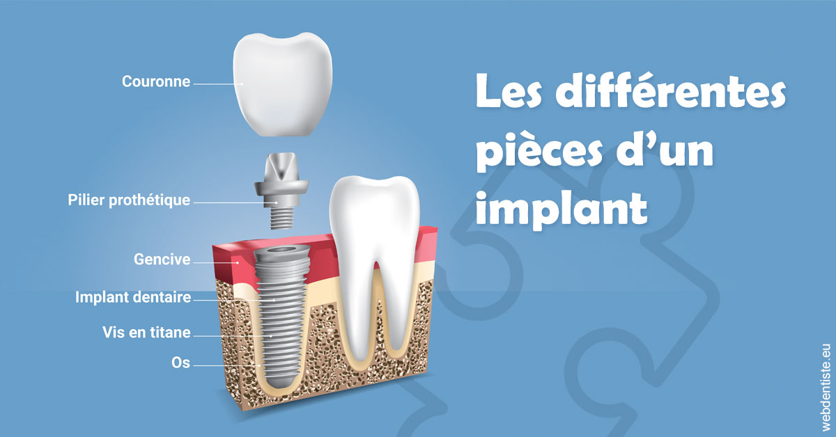 https://www.cabinetdentaire-etoile.fr/Les différentes pièces d’un implant 1